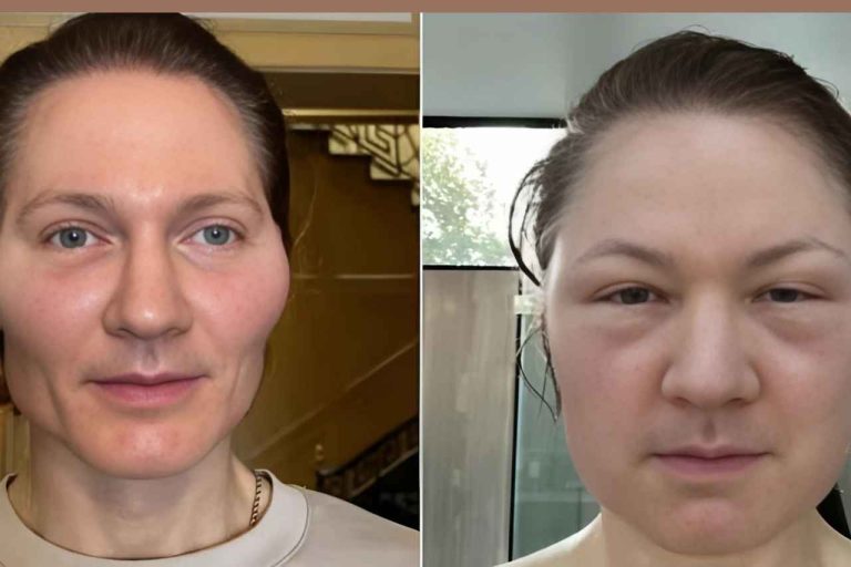 Tech Millionaire Bryan Johnson’s ‘Project Baby Face’ Faces Setback After Severe Allergic Reaction