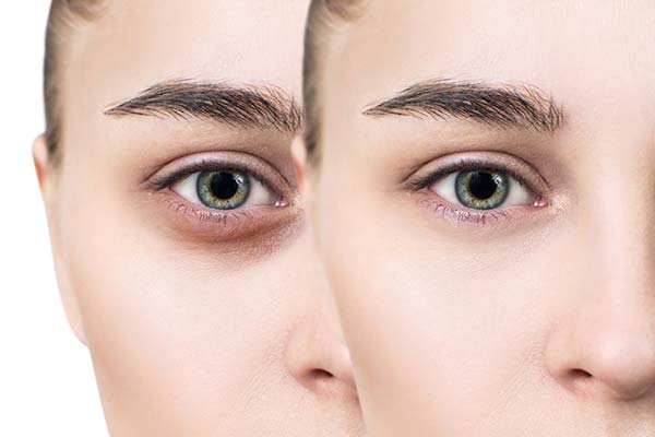 Effective Tips for Reducing Dark Circles: A Comprehensive Guide
