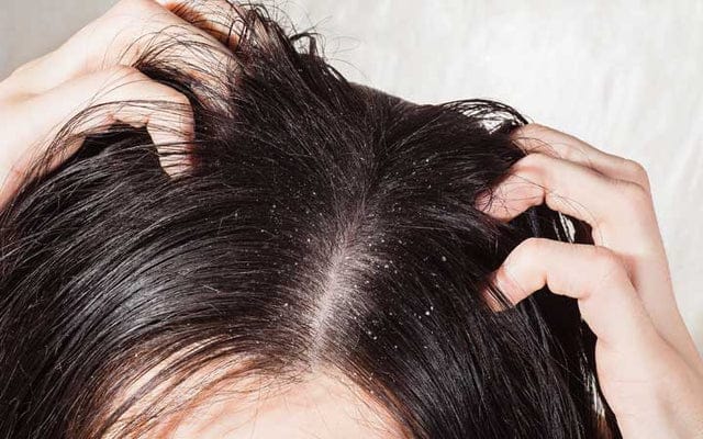 Say Goodbye to Dandruff: Proven Strategies for a Flake-Free Scalp