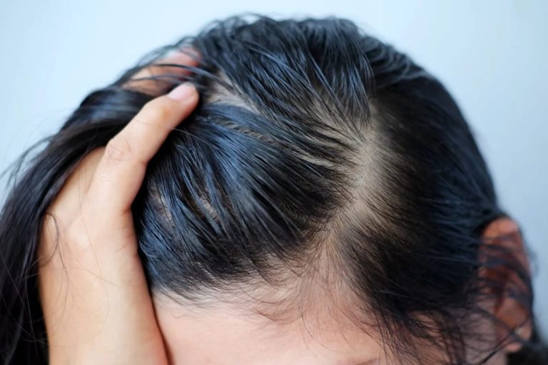 Effective Treatments for Oily Scalp: Tips and Remedies for Balanced Hair Health Effective Treatments for Oily Scalp: Tips and Remedies for Balanced Hair Health