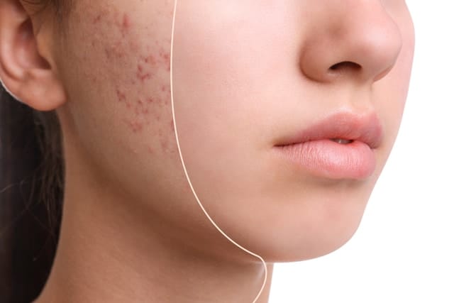 Effective Remedies for Pimples: Clear Skin Solutions