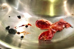 Kolkata Patient Loses Appendix