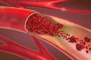 India Approves Supernova Stent Retriever