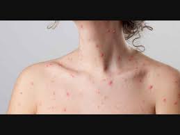 Chickenpox in Kerala: 100 New Cases Raise Serious Health Concern Across Kollam
