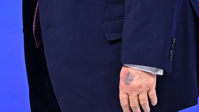 Trump Hand Bruise: Shocking Explanation Amid Growing Health Concerns