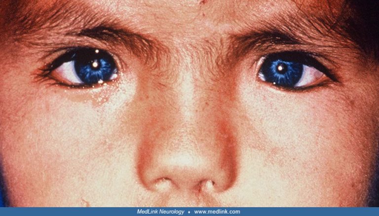 Waardenburg Syndrome Draws Attention for Its Rare Genetic Identity